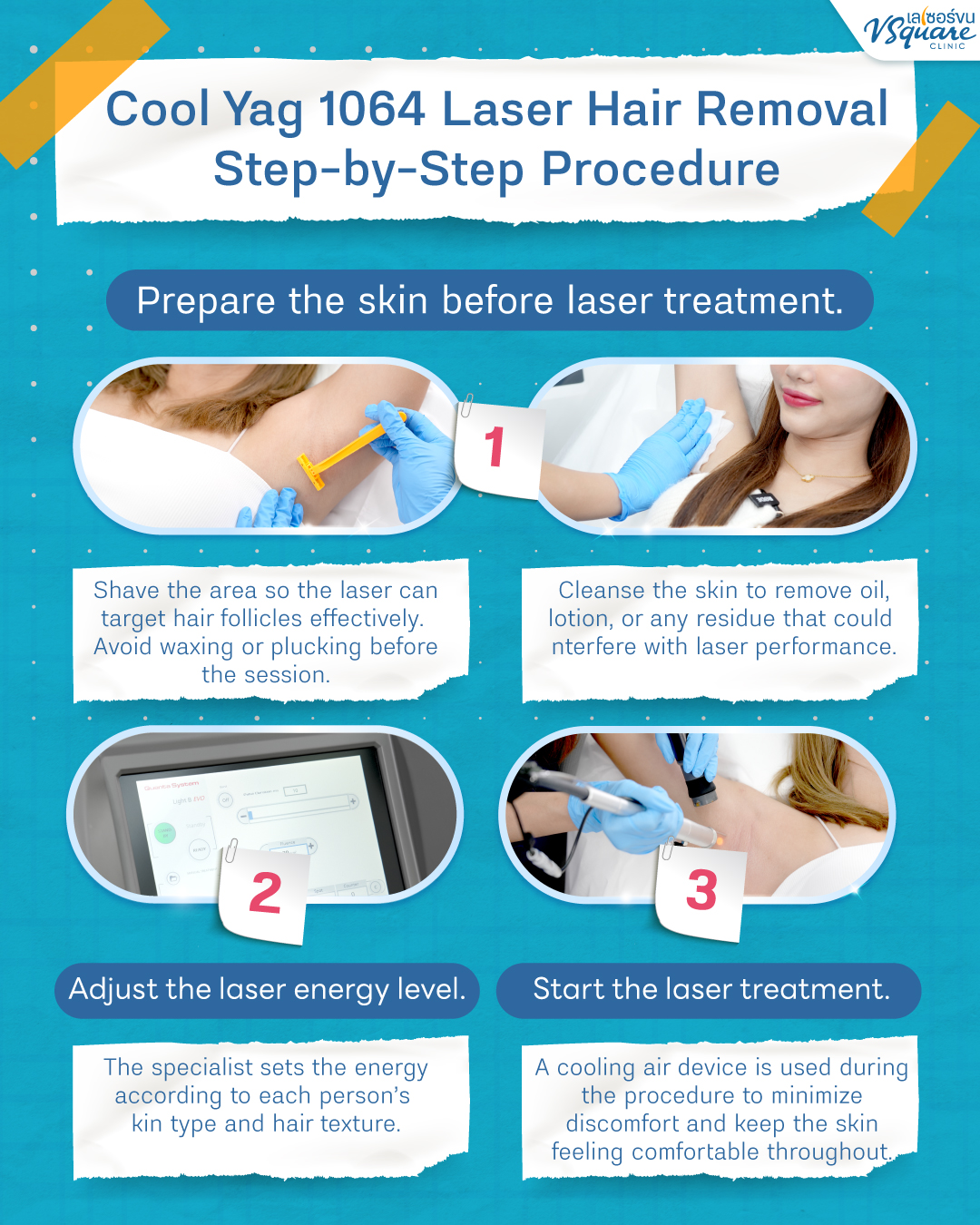 Laser hair removal procedure.