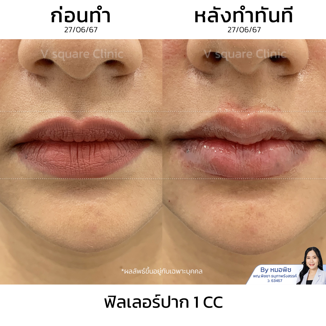 Lip Filler Cupid’s Bow Review โดย หมอ พิช