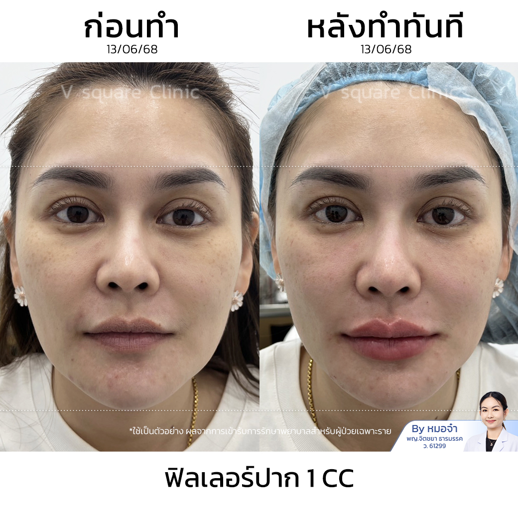 Lip Filler Review_ณิชชาภัทร โดย หมอจ๋า
