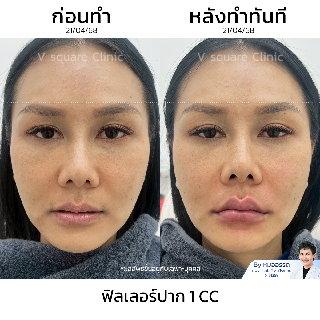 Lip Filler Review_สุภาภรณ์ ทำลา โดย หมอรรถ