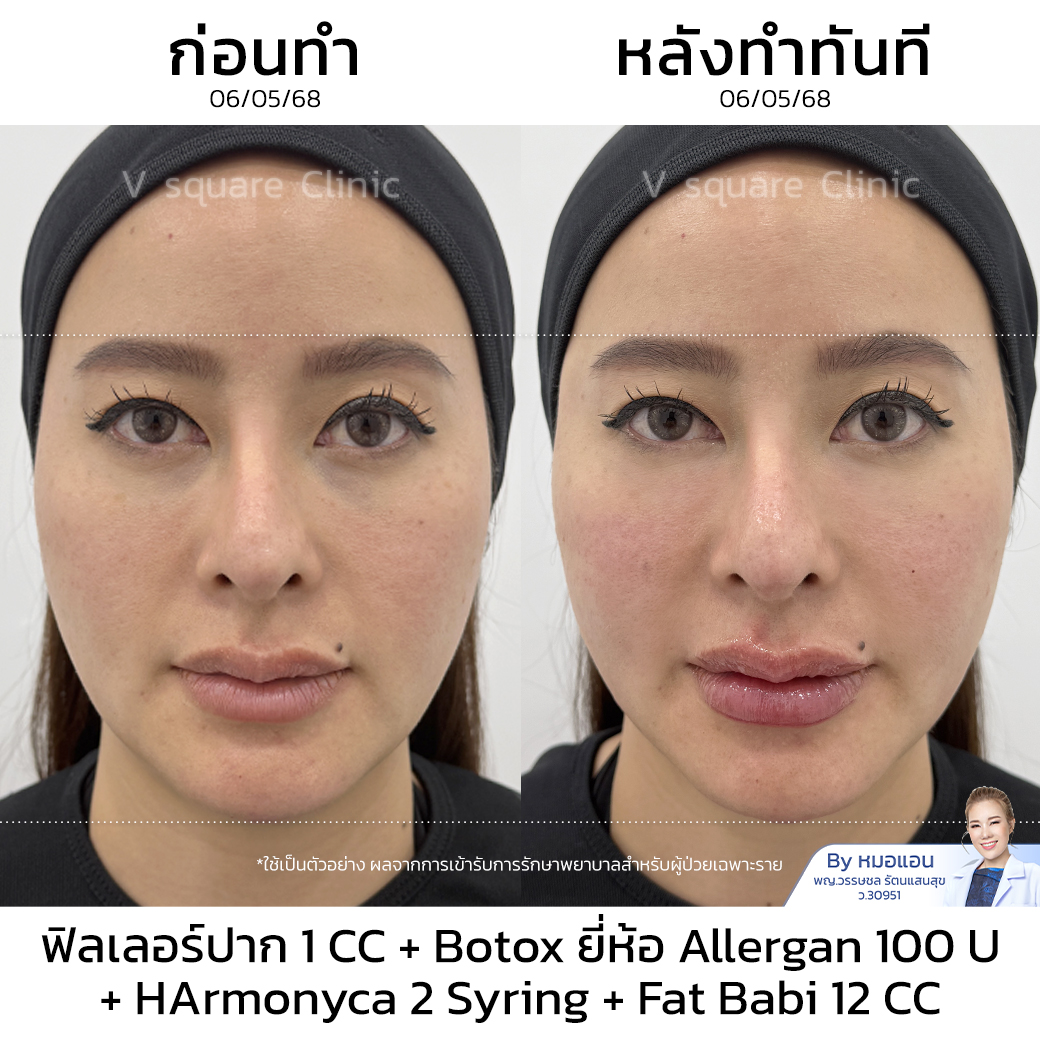 Lip Filler Review_ส้ม โดย หมอแอน