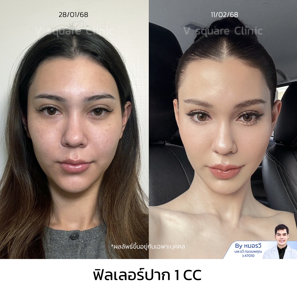 Lip Filler Review_เอมี่ โดย หมอรวี