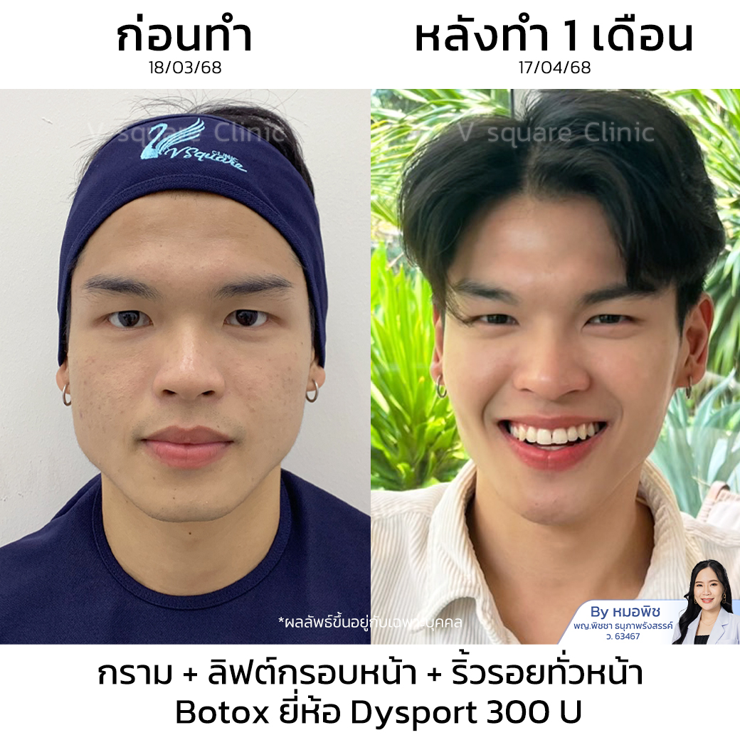 Masseter Botox Review_ คุณบอส by หมอ พิช