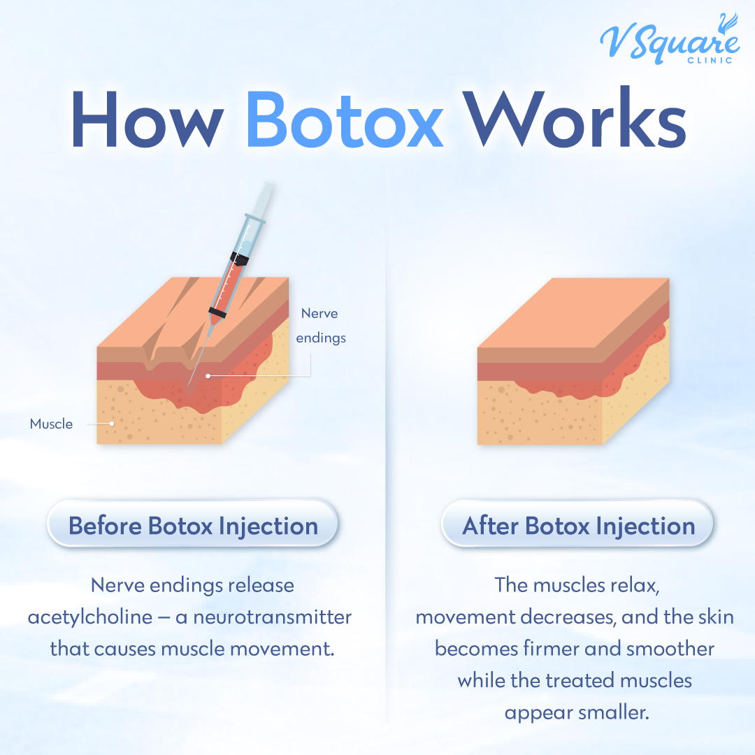 Mechanism of Botox action