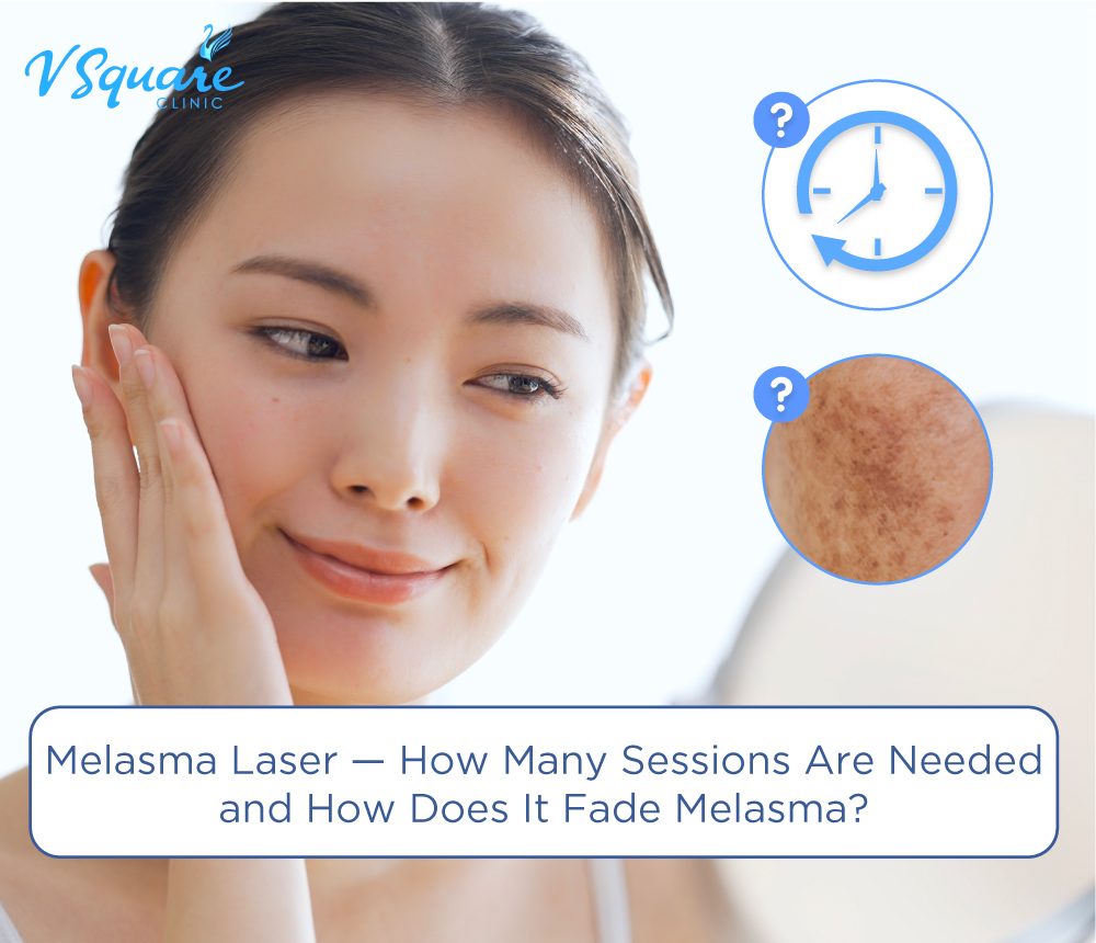 Melasma laser