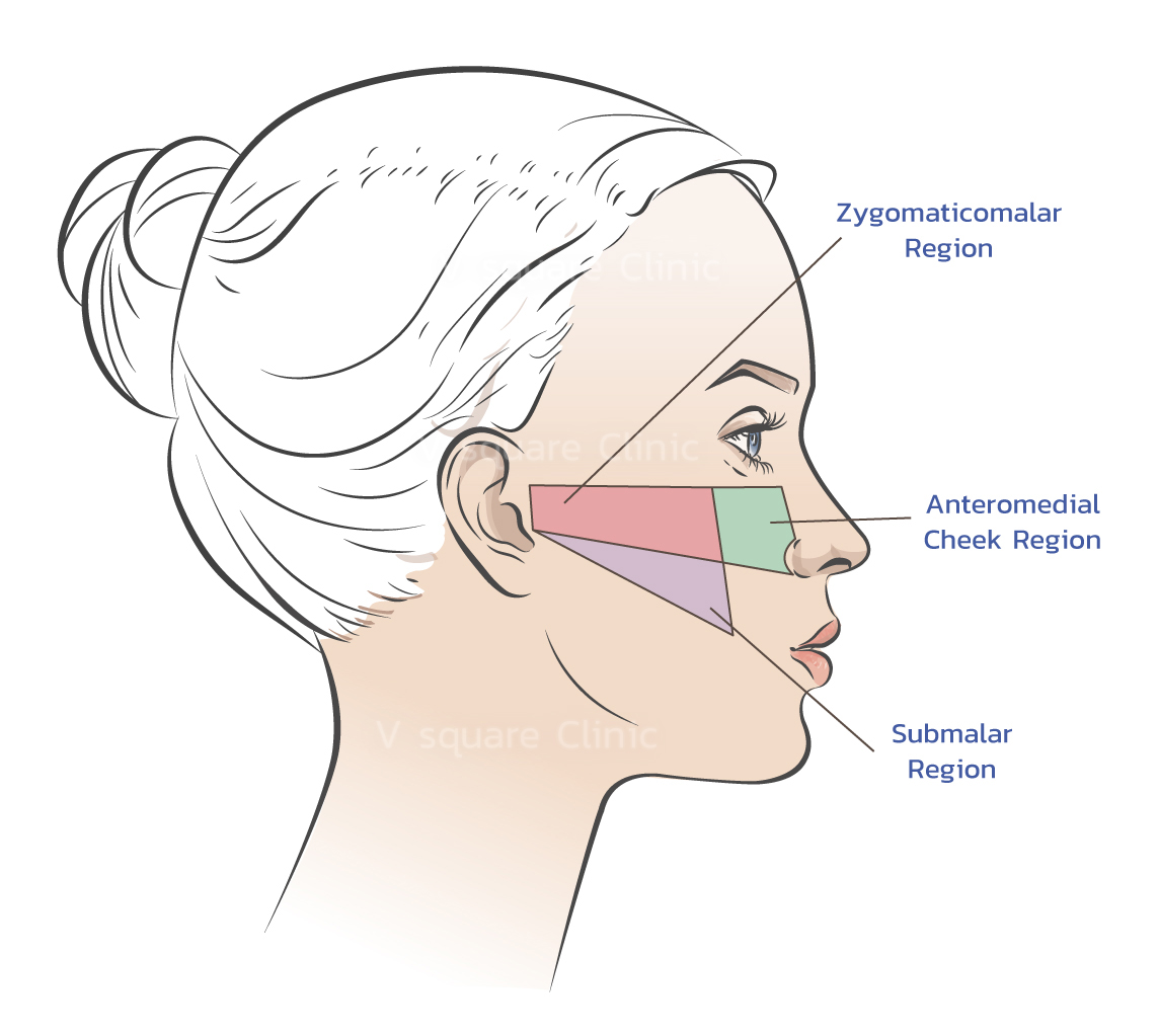 Midface areas for Orange Cheek Filler