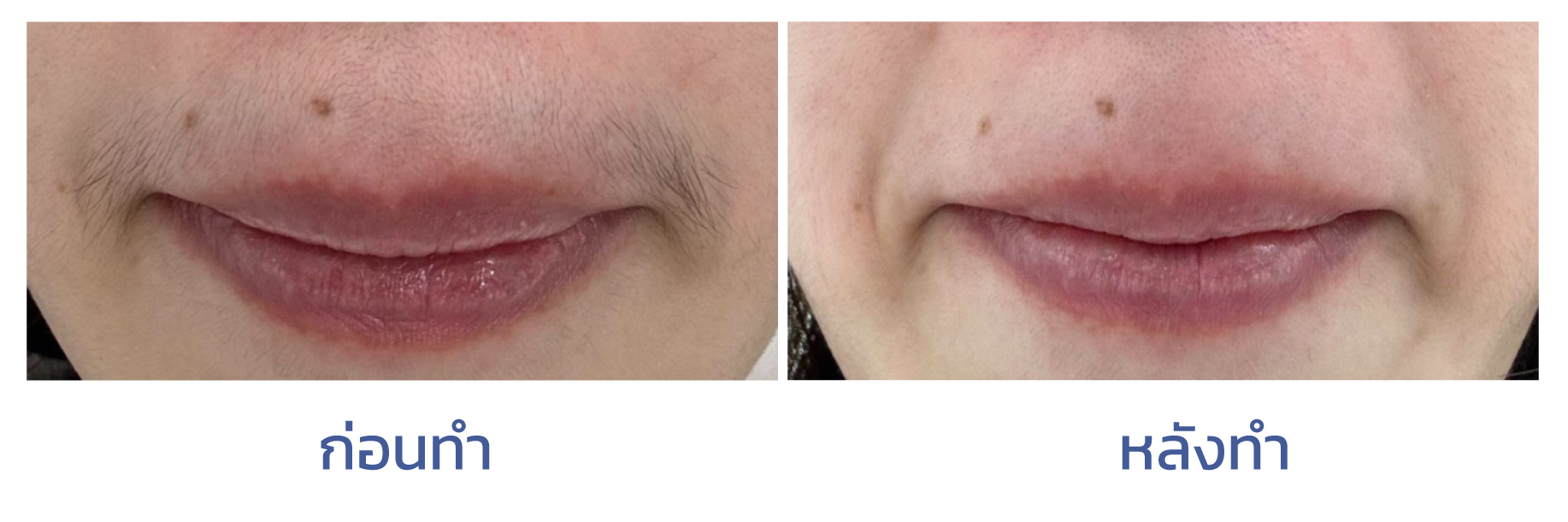 Mustache Laser Review