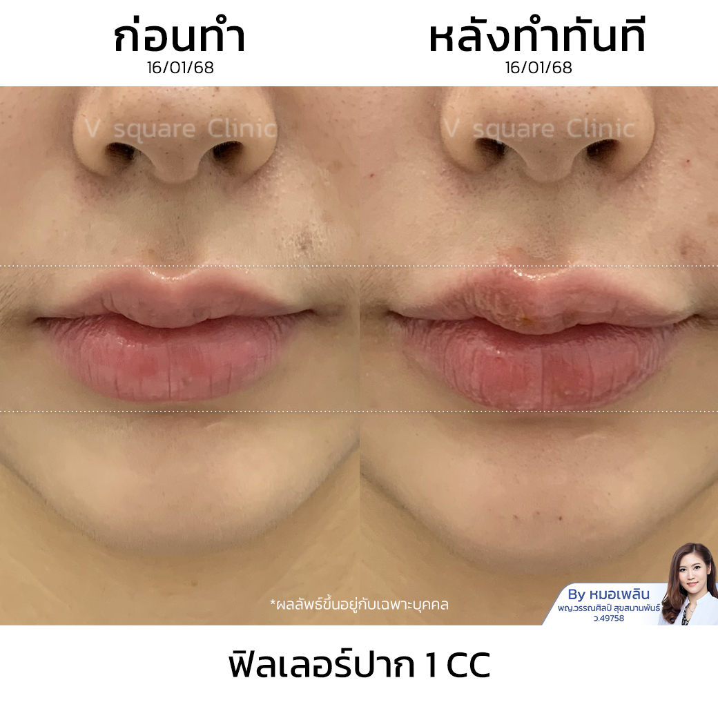 Review Cupid’s Bow Lip Filler โดย หมอ เพลิน
