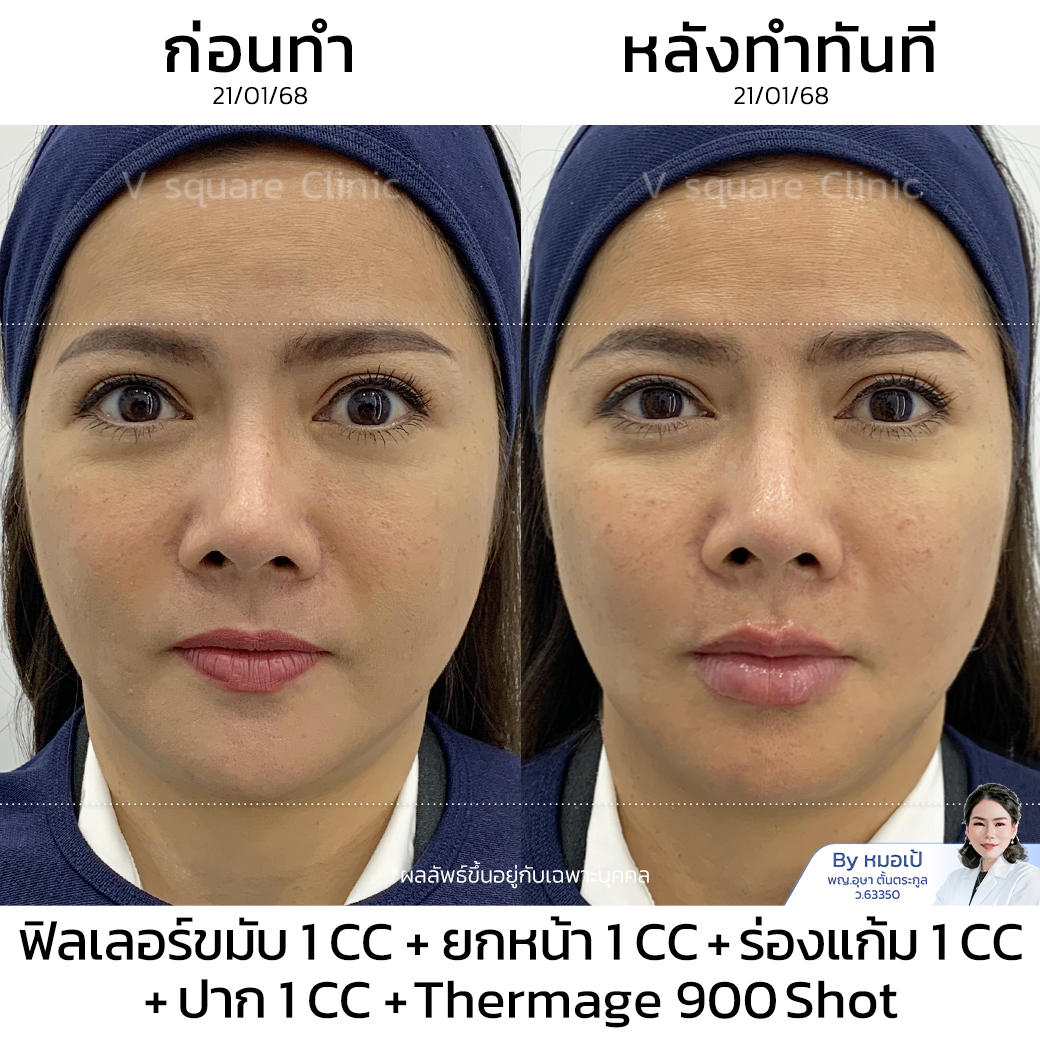Review Thermage_พี่ปุ้ย โดย หมอ เป้
