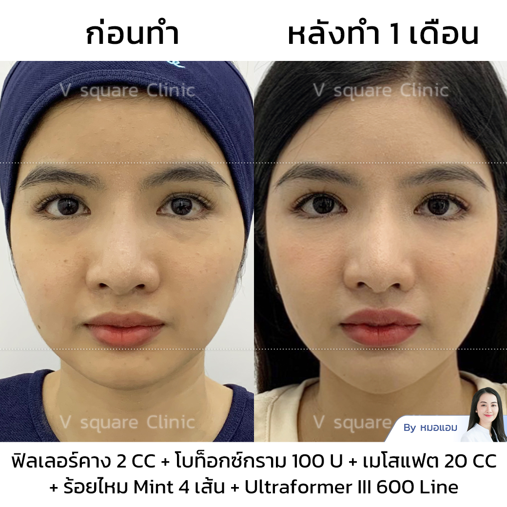 Review of Botox for jaw reduction_คุณซานตี้_Influencer_(คอนเทนต์หน้าเรียว) โดย หมอแอม