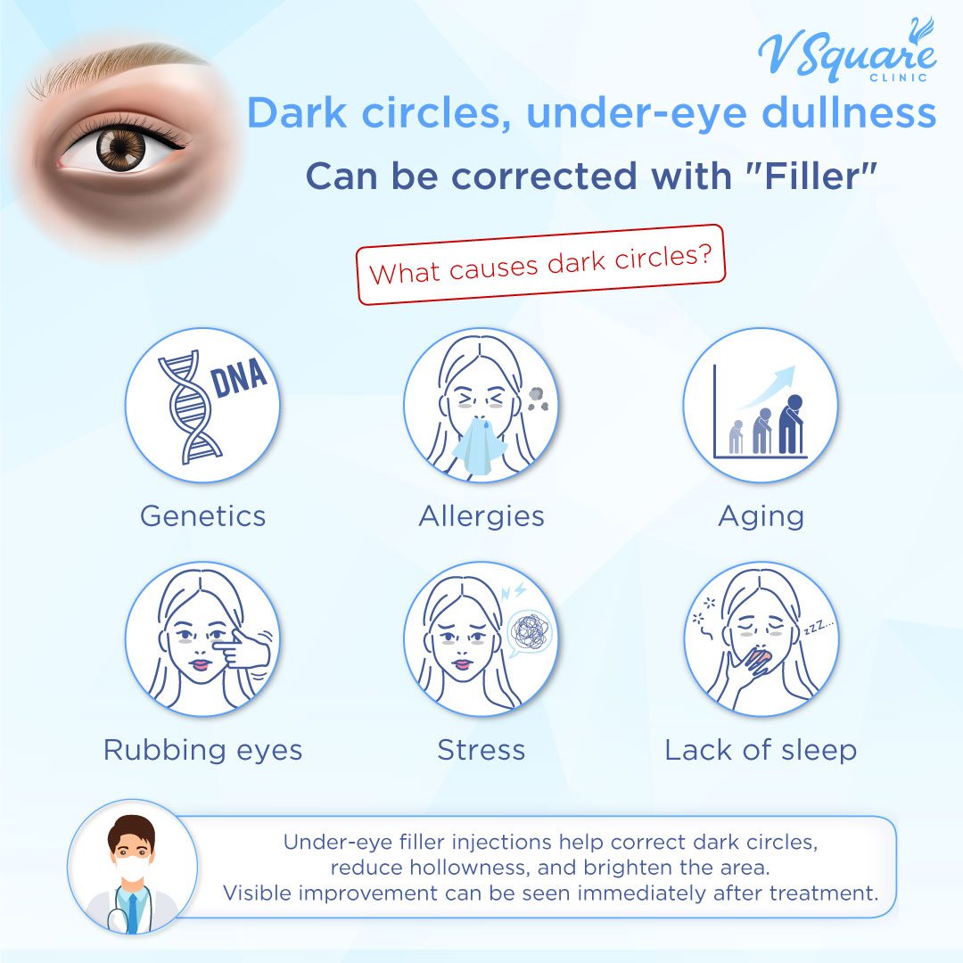 Severe Dark Circles treated with filler