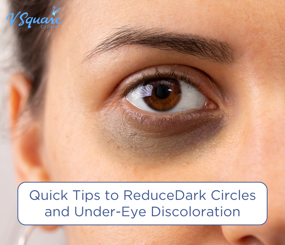 Severe Dark Circles