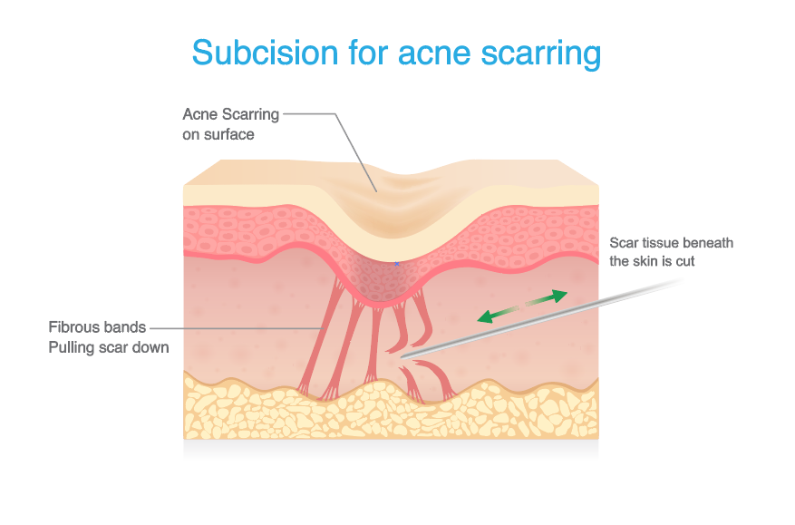 Subcision acne scars