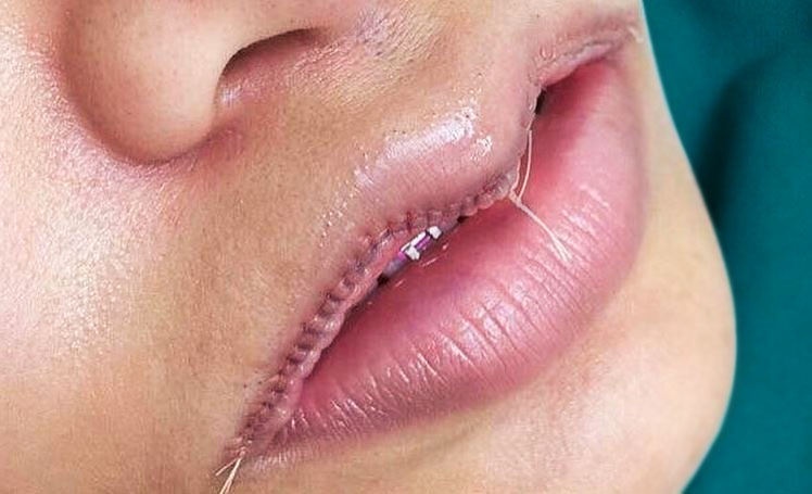 Surgical Cupid’s Bow Lips
