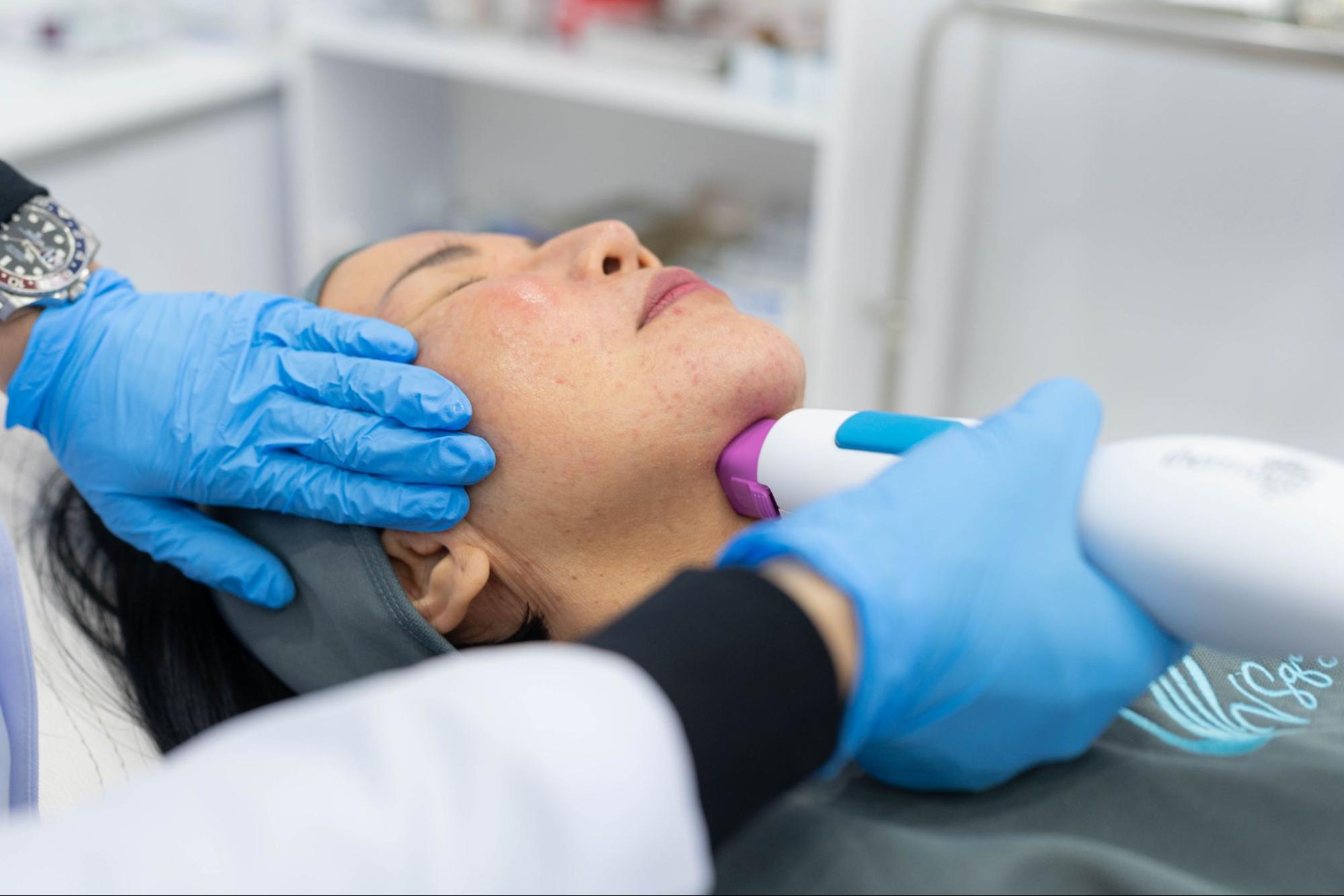 Thermage FLX Double Chin Reduction