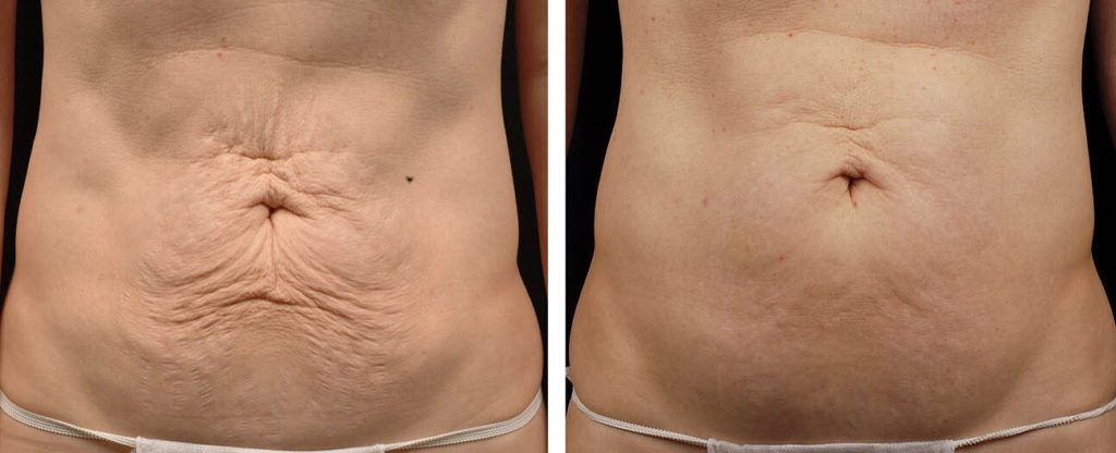 Thermage FLX for body