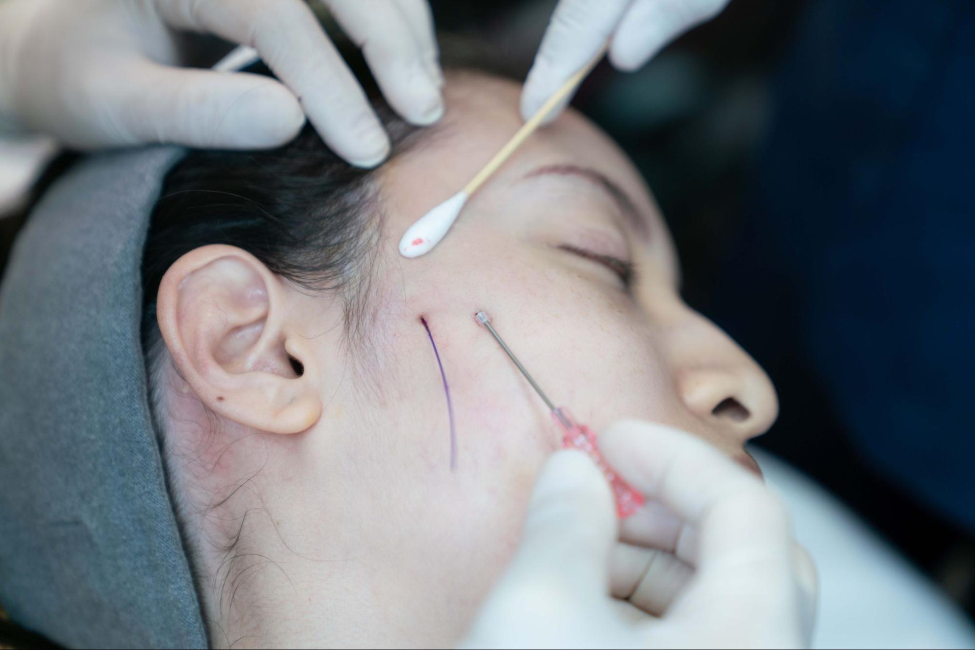 Thread lifting for facial tightening