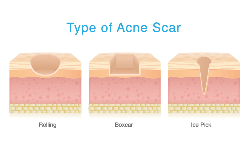 Types of acne scars
