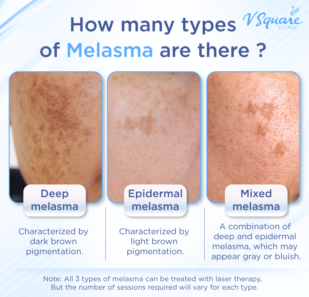 Types of melasma