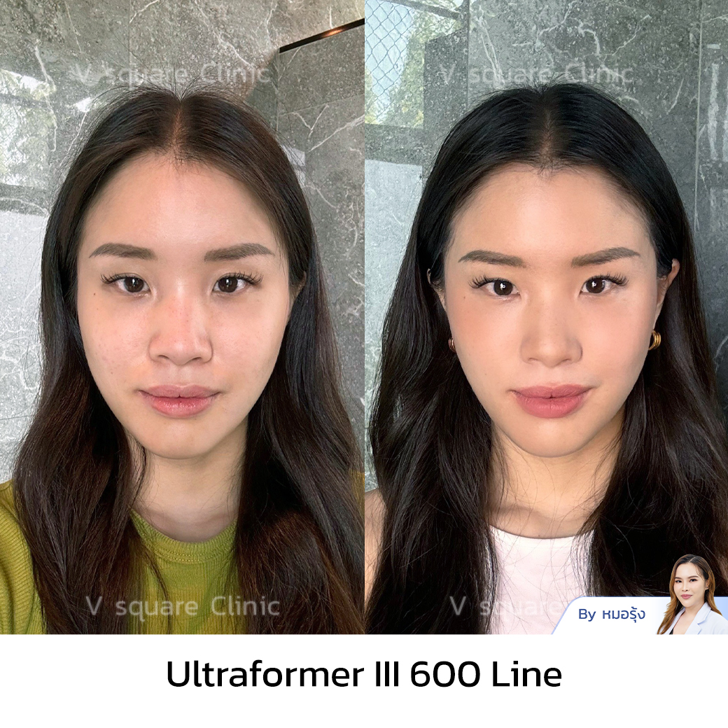 Ultraformer III Review_คุณแน้น Influencer By Dr.Narumol Jitnarong