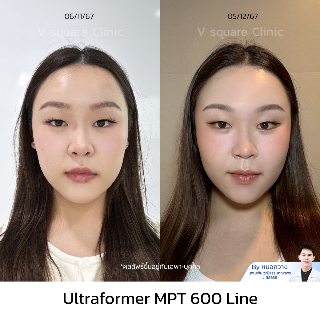 Ultraformer MPT Review_คุณเหวิน โดย หมอกวาง