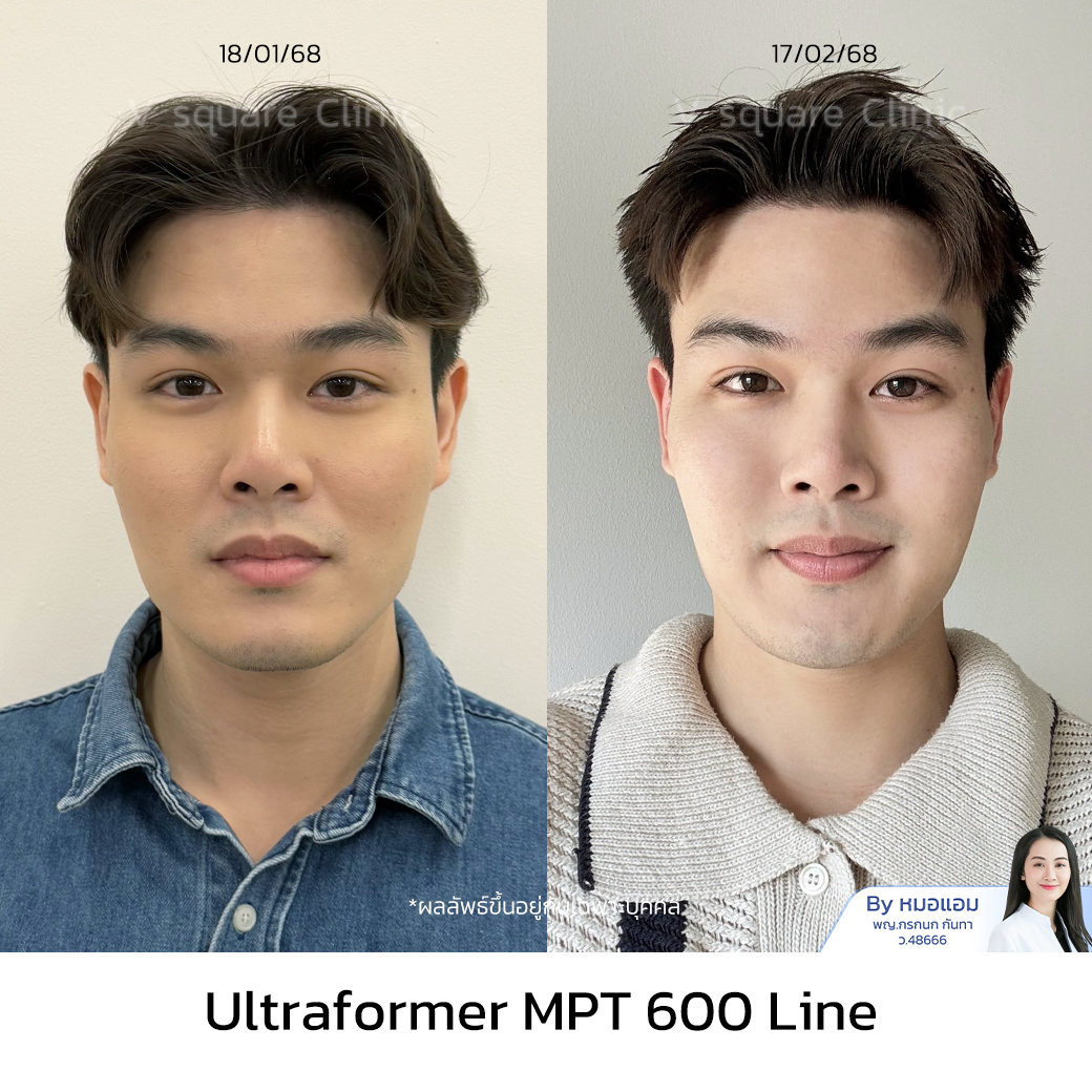 Ultraformer MPT Review_ทอย โดย หมอแอม