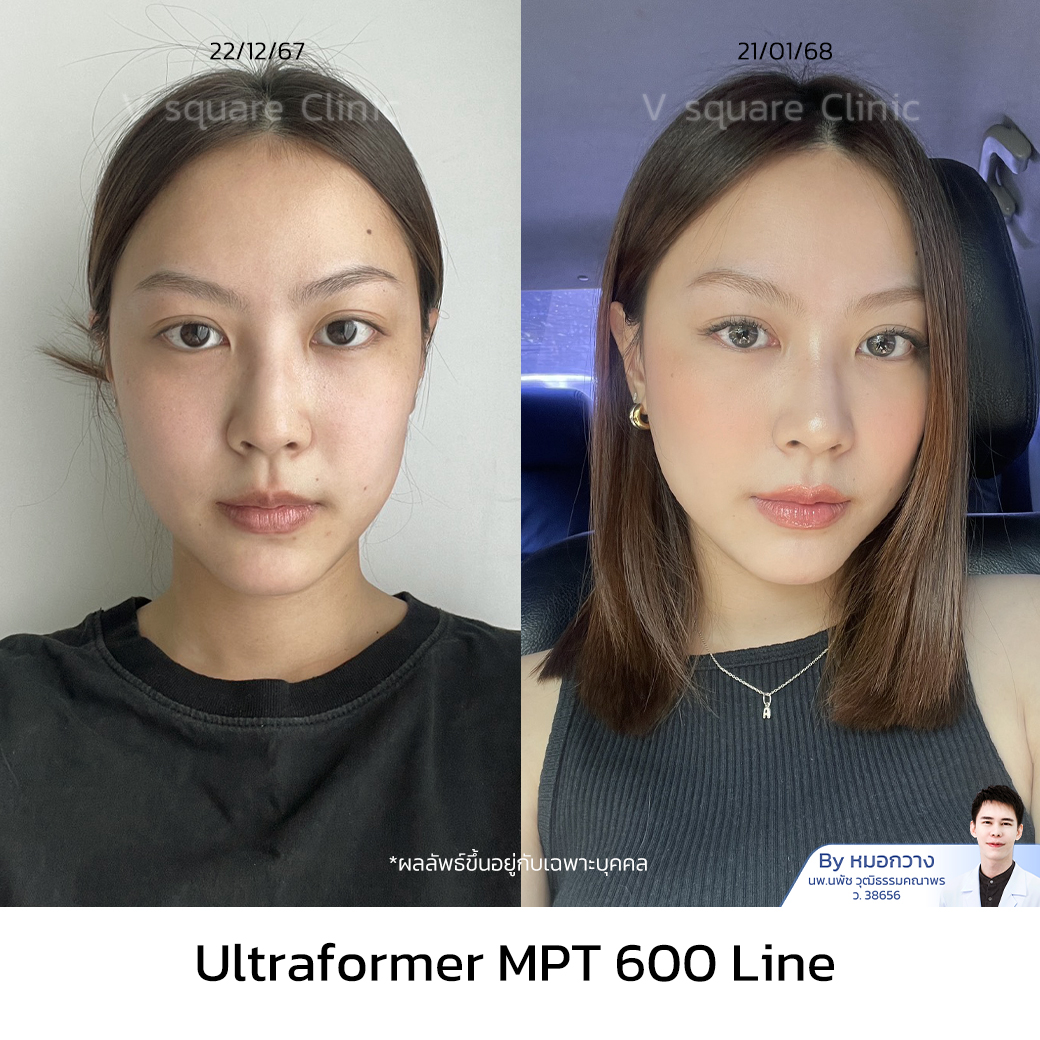 Ultraformer MPT Review_นิว โดย หมอกวาง