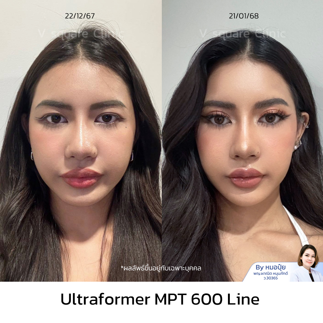 Ultraformer MPT Review_บินนี่ โดย หมอ ปุ๋ย