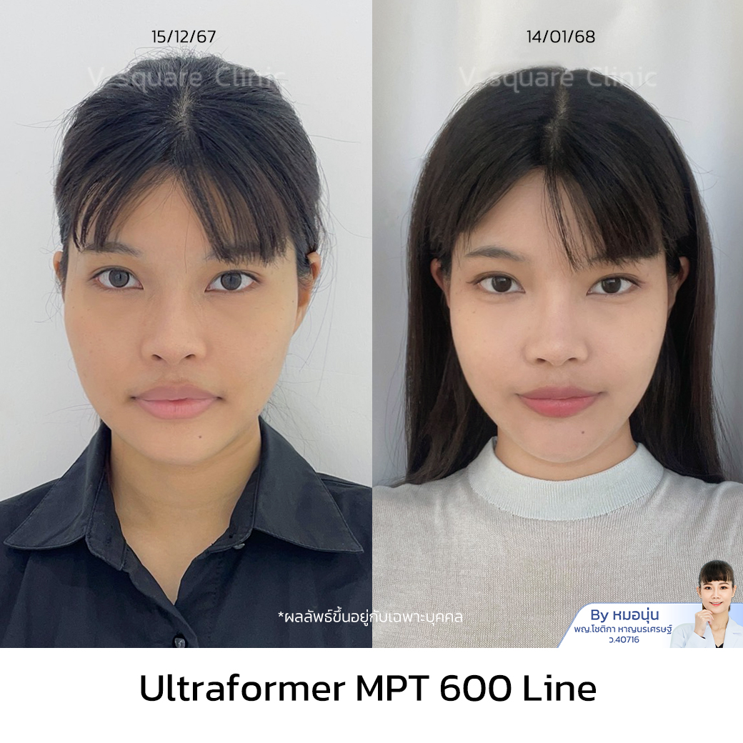Ultraformer MPT Review_ว่าน โดย หมอนุ่น