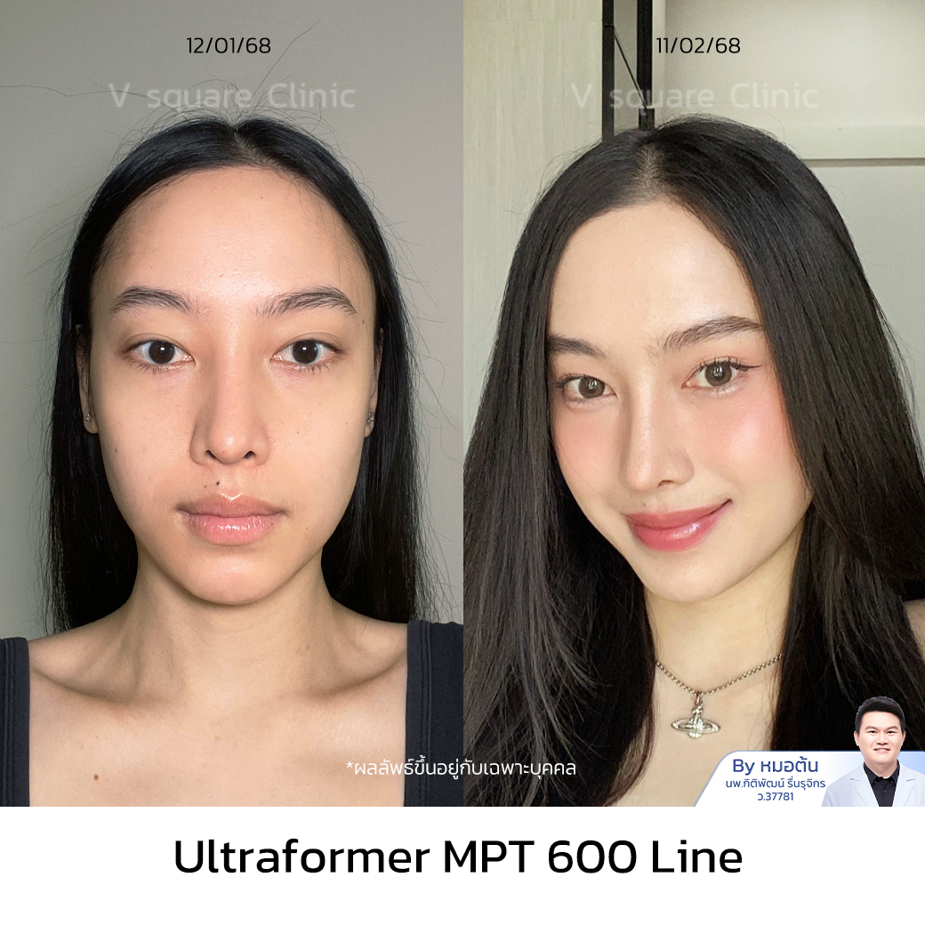 Ultraformer MPT Review_เกมส์ โดย หมอ ต้น