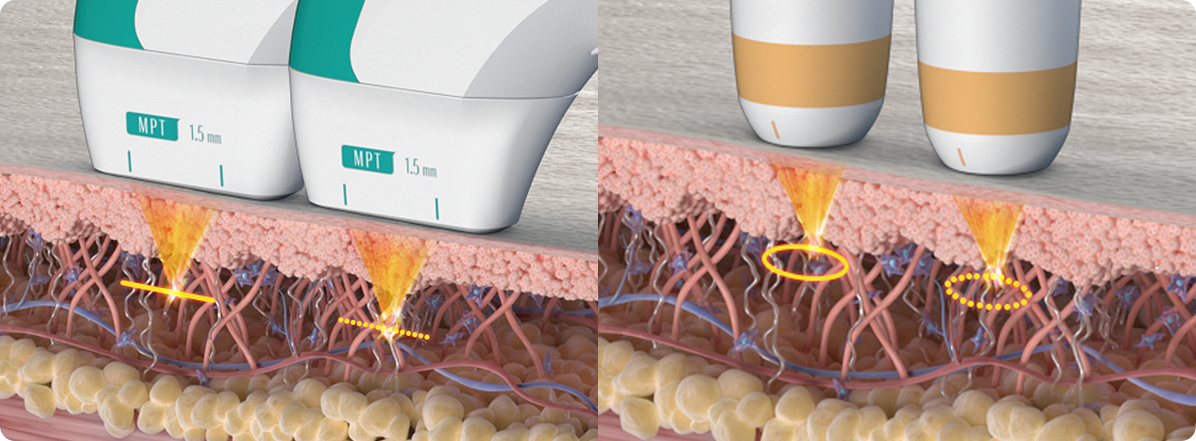 Ultraformer MPT energy delivery modes