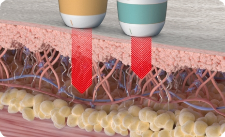 Example of Ultraformer III machine