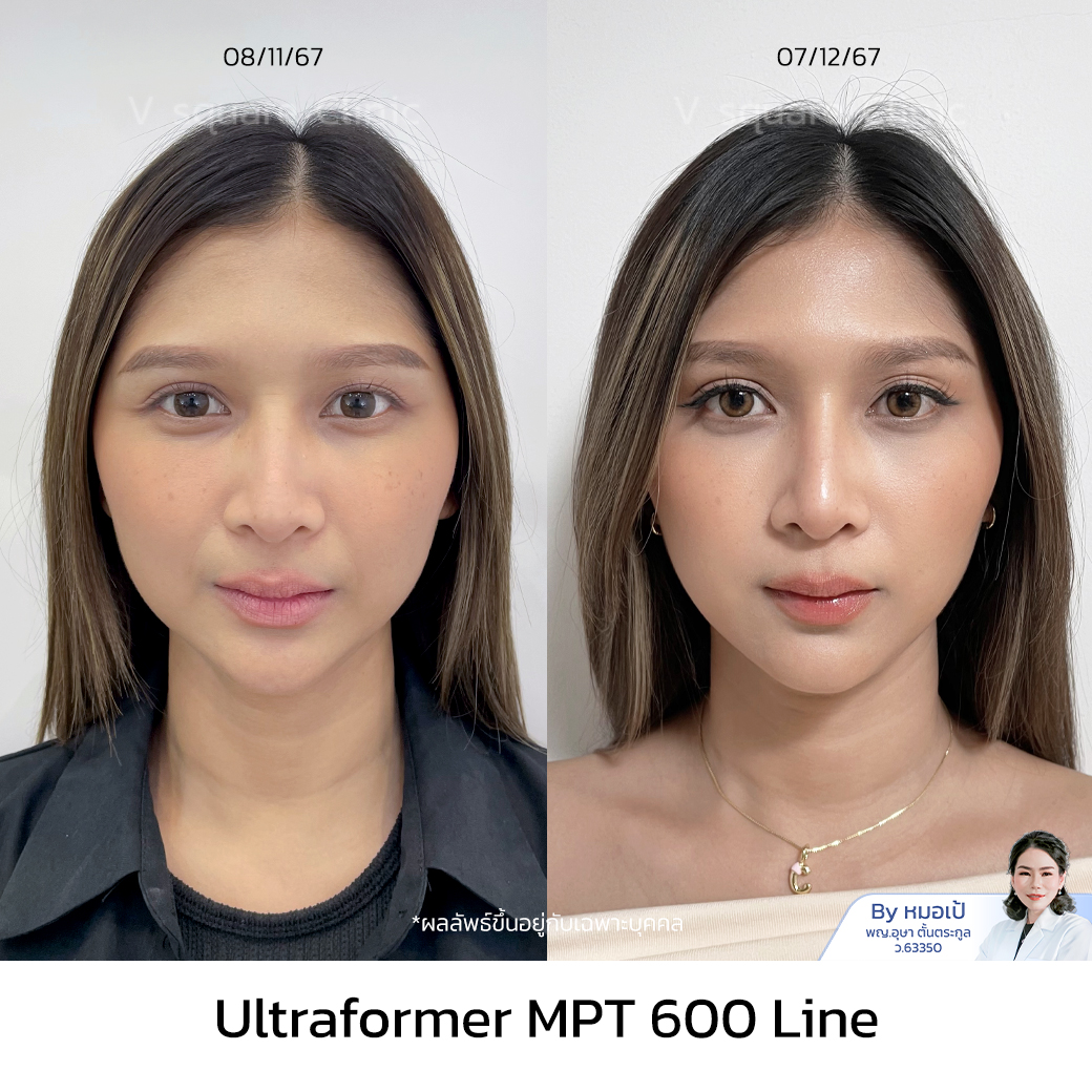 Ultraformer MPT review worth the price_พี่ครี โดย หมอเป้