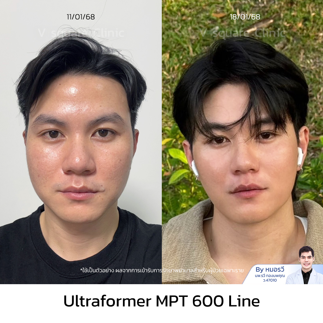 Ultraformer MPT review worth the price_แฟร้ง โดย หมอรวี