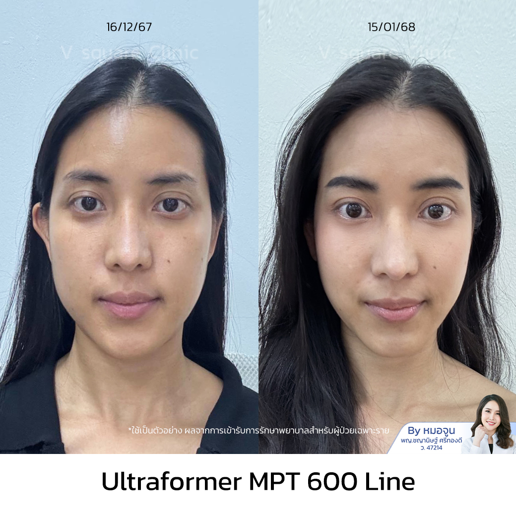 Ultraformer MPT review_เอม โดย หมอจูน