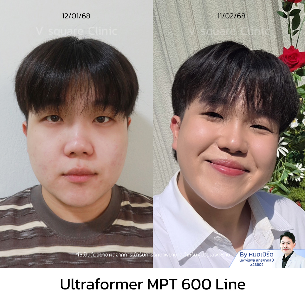 Ultraformer MPT review_แท็ค โดย หมอเบิร์ด