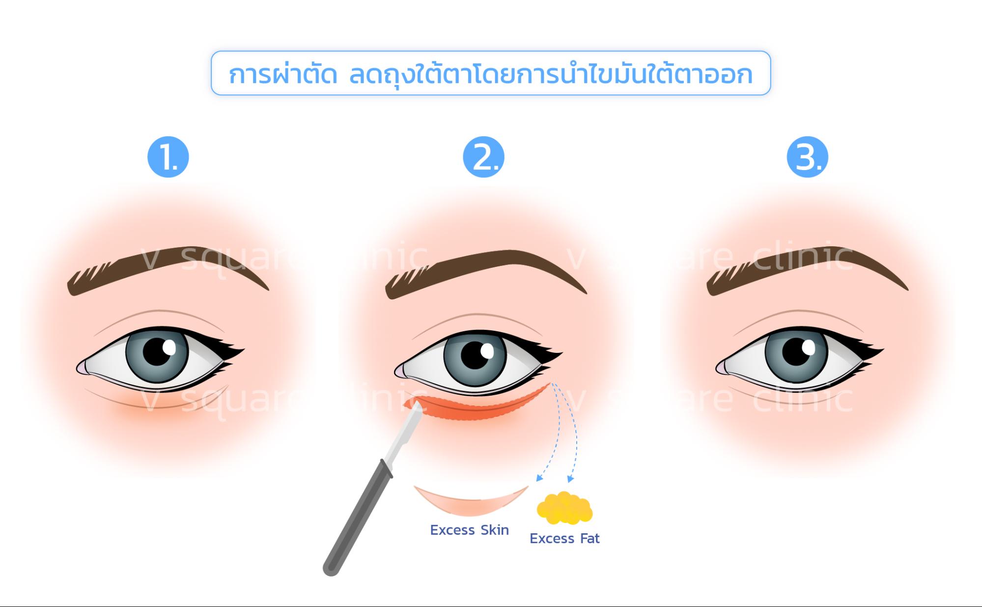 Under-Eye Bag Surgery