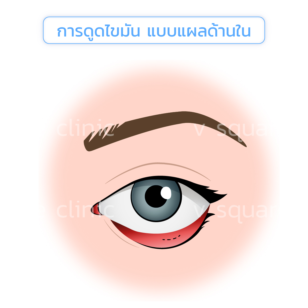 Under-Eye Fat Removal – Inner Incision