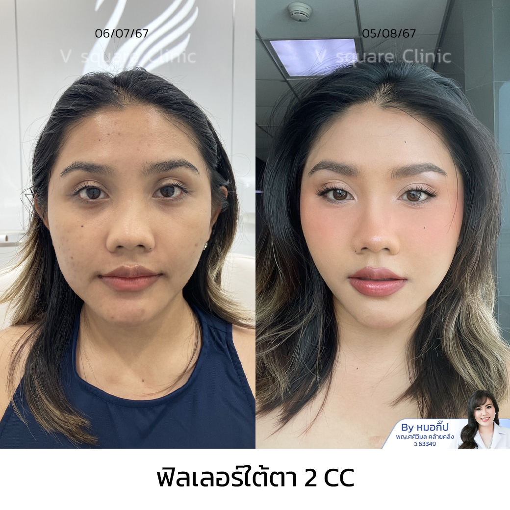 Under-eye filler injection_คุณเพลง อินฟลู โดย หมอกิ๊ฟ