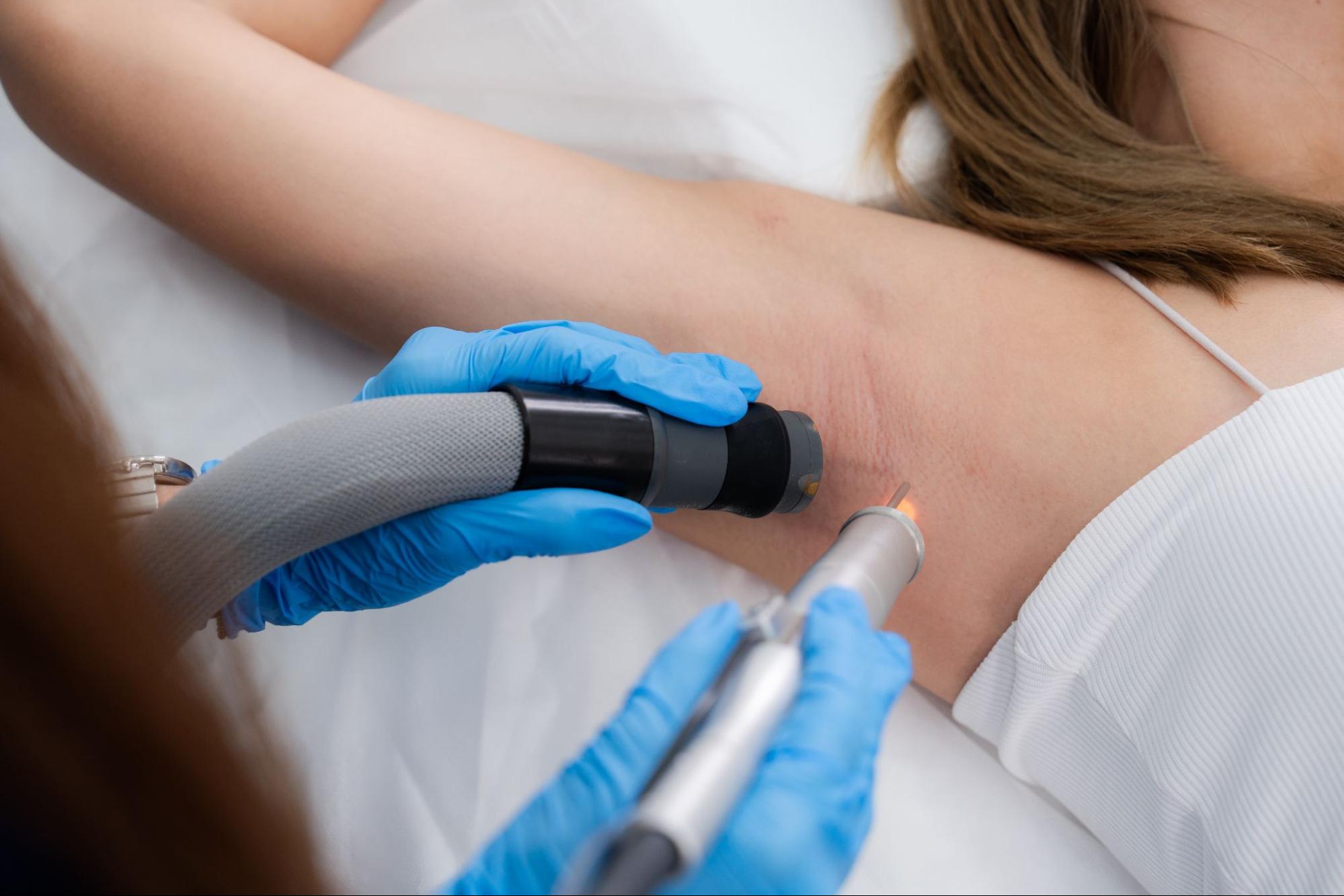 Underarm hair laser machine