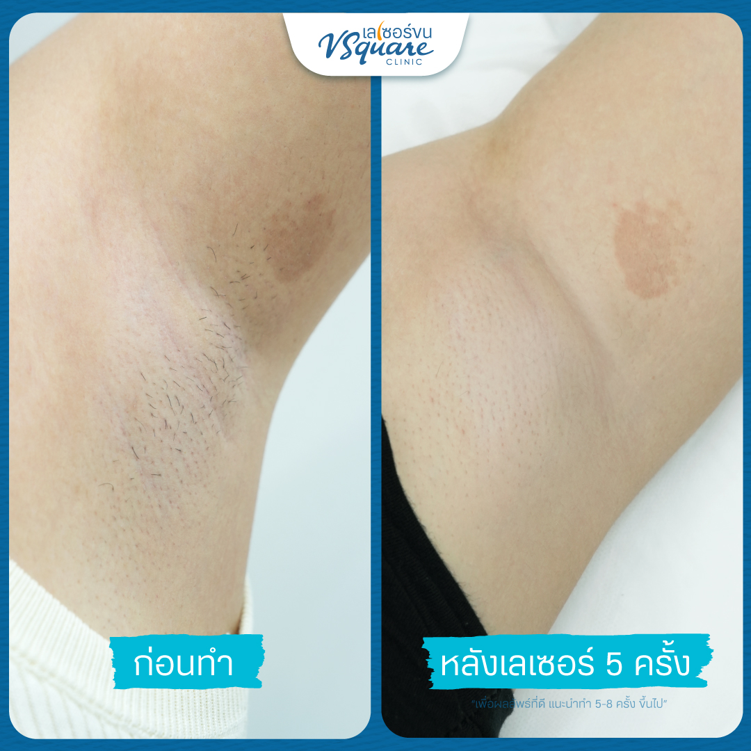 Underarm laser hair removal review