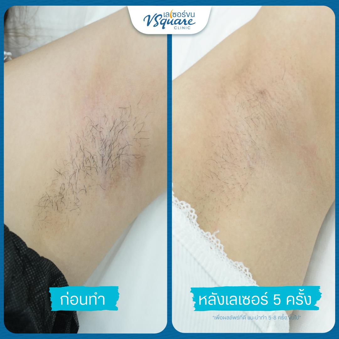 Underarm laser review