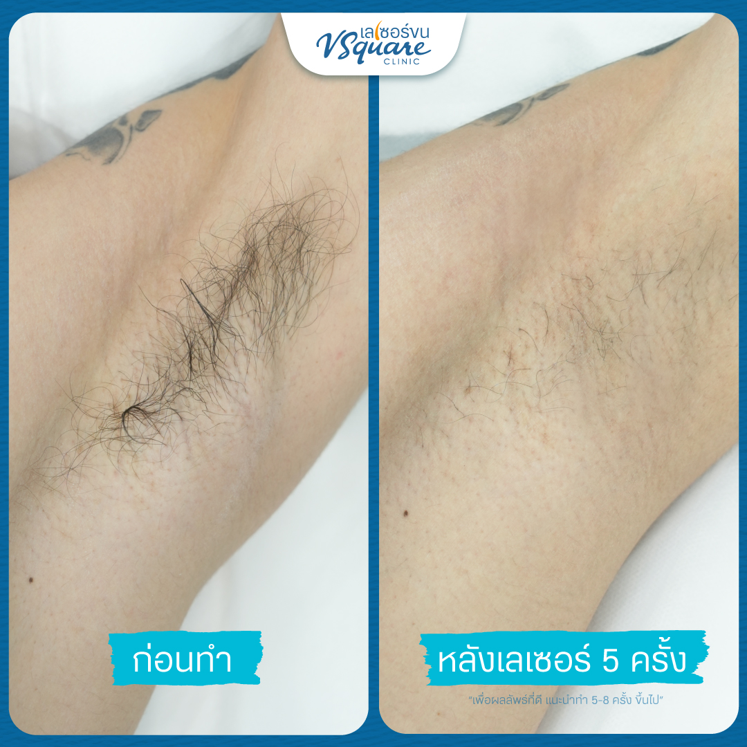 Underarm laser treatment review