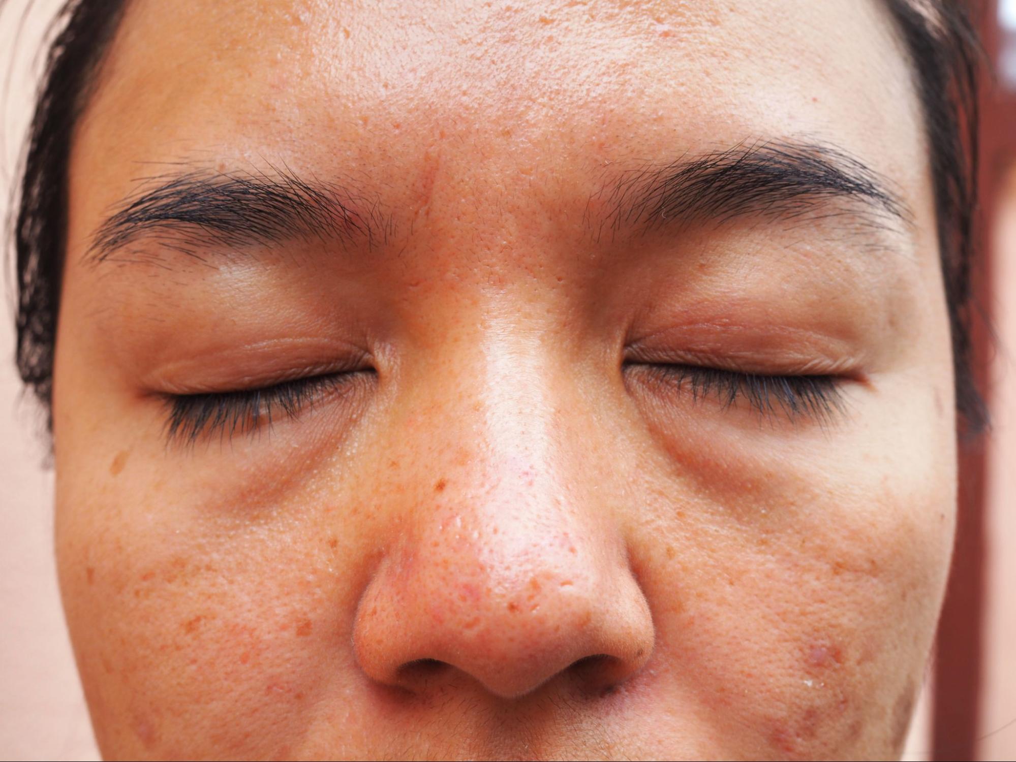 What Are Under-Eye Bags