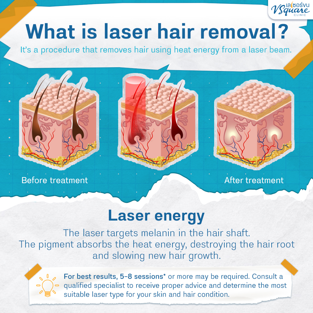 What is a laser hair removal machine