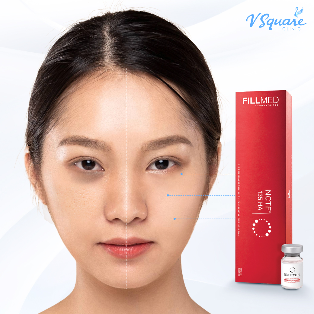 Which areas can Filorga be injected