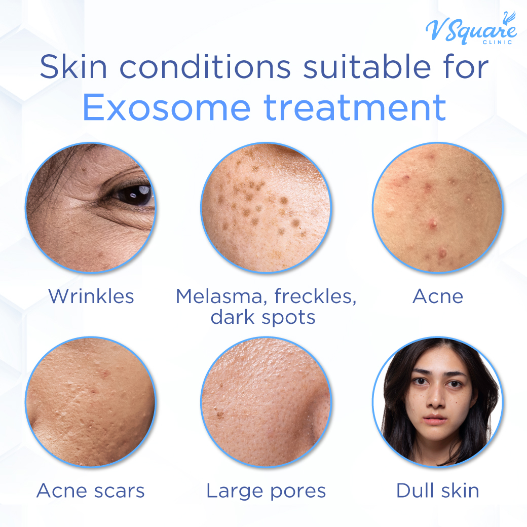 Who is exosome suitable for