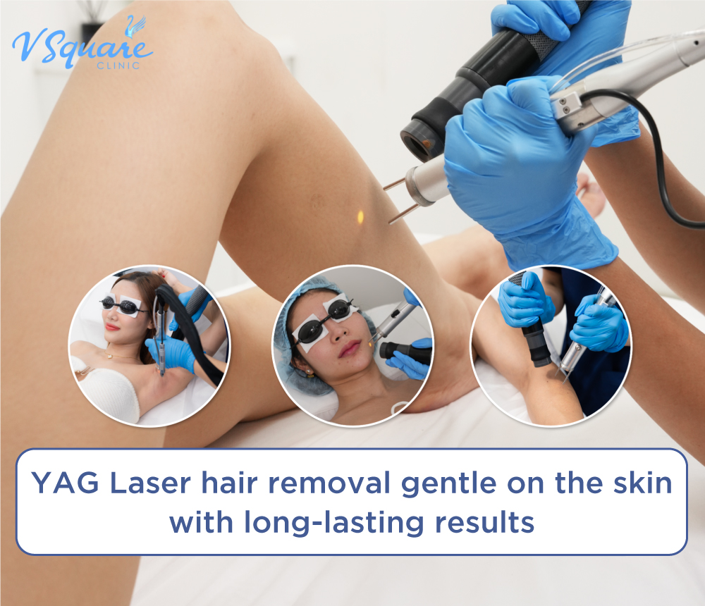 YAG Laser