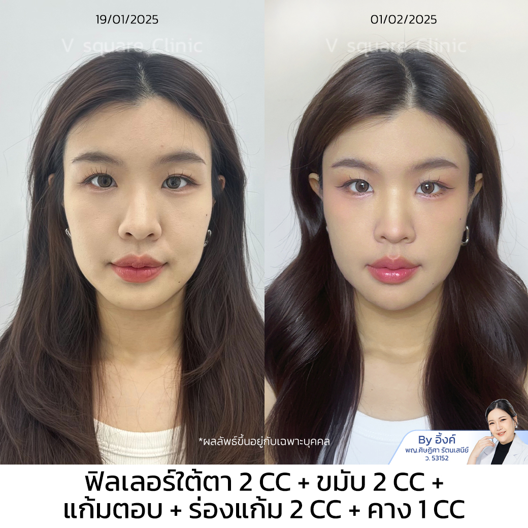 filler HA review_น้ำ by หมออิ้งค์