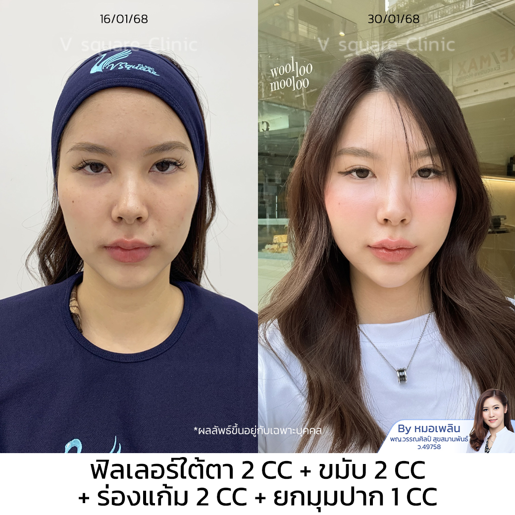 filler HA review_เฟิร์น By หมอเพลิน